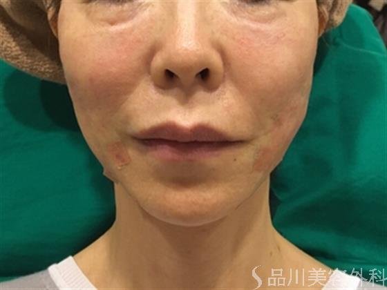 症例NO.24564のAFTER写真