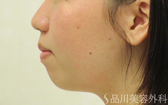 症例NO.69594のBEFORE写真