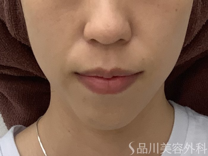 症例NO.67892のBEFORE写真