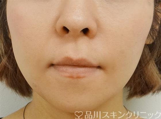 症例NO.36108のBEFORE写真
