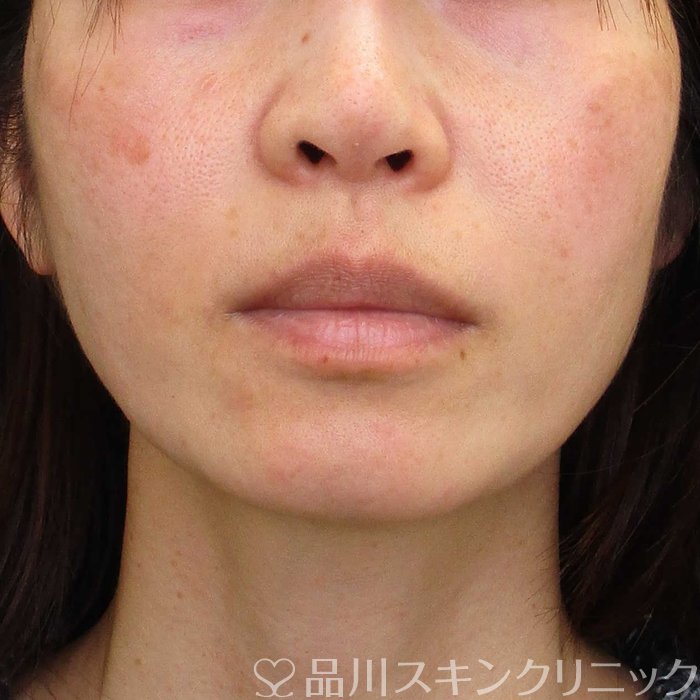 症例NO.65479のBEFORE写真