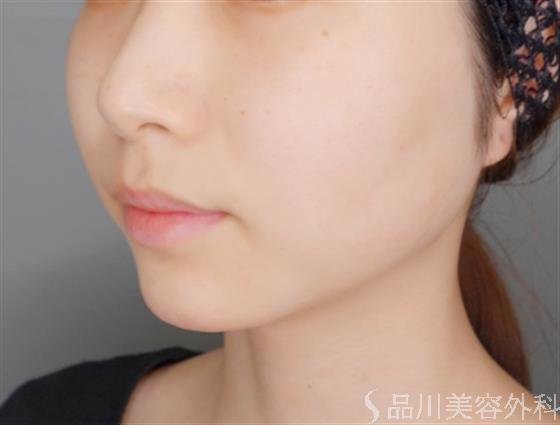 症例NO.54150のAFTER写真