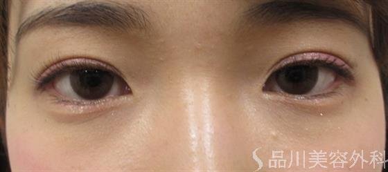 症例NO.35069のAFTER写真