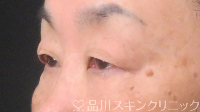 症例NO.66550のBEFORE写真