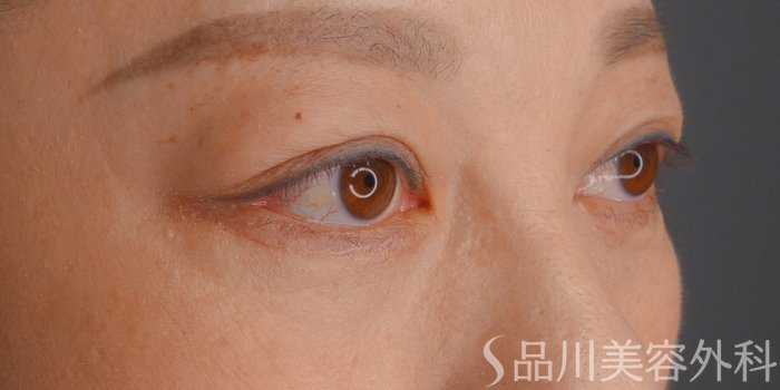 症例NO.73725のAFTER写真