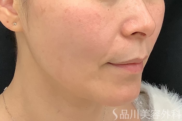 症例NO.73322のBEFORE写真