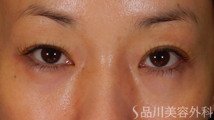 症例NO.69930のBEFORE写真