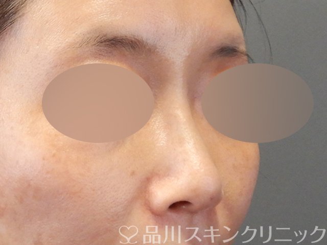 症例NO.67536のAFTER写真