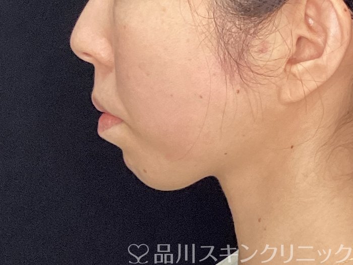 症例NO.72605のAFTER写真