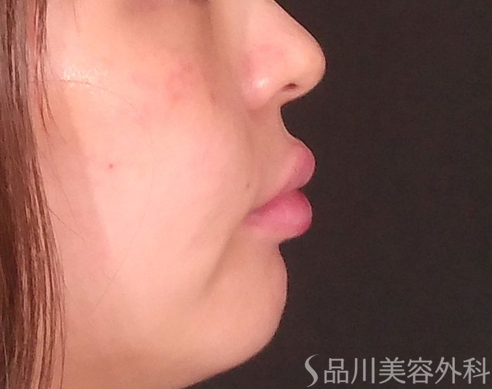 症例NO.70525のAFTER写真