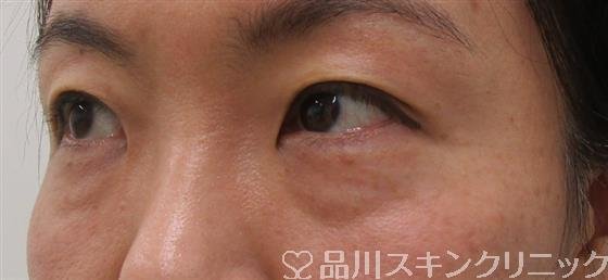 症例NO.52427のBEFORE写真
