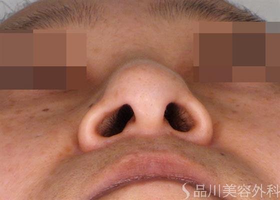 症例NO.47402のBEFORE写真