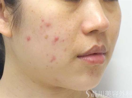 症例NO.26263のBEFORE写真