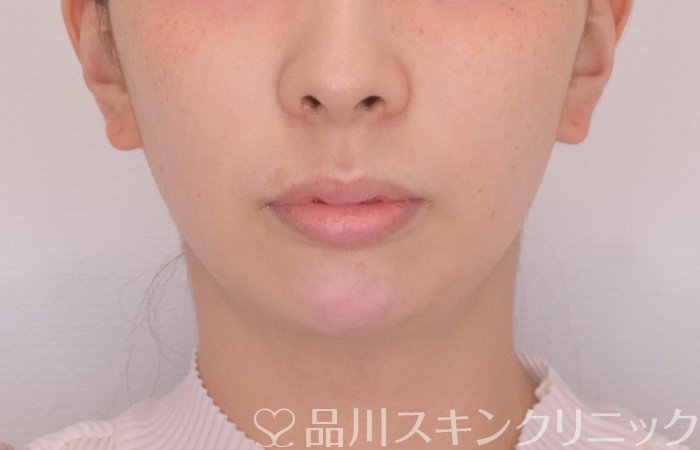 症例NO.69318のAFTER写真