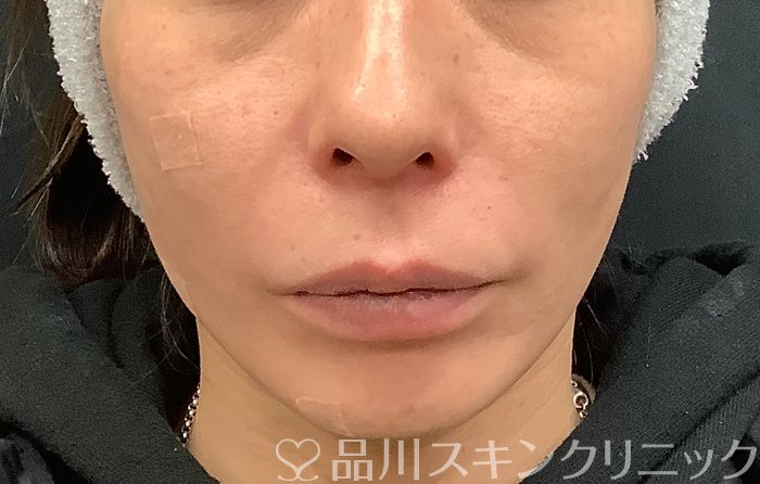 症例NO.69485のAFTER写真