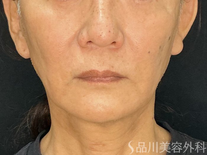 症例NO.71749のBEFORE写真