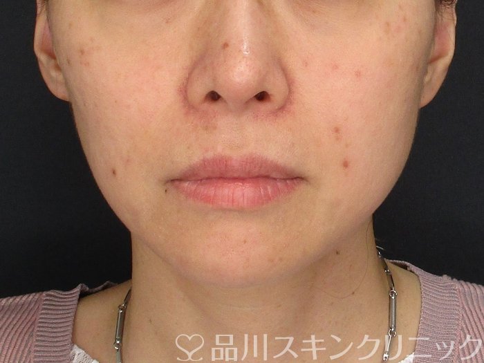 症例NO.74284のBEFORE写真