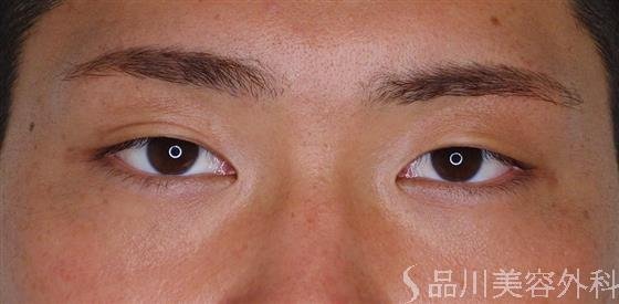 症例NO.48481のBEFORE写真