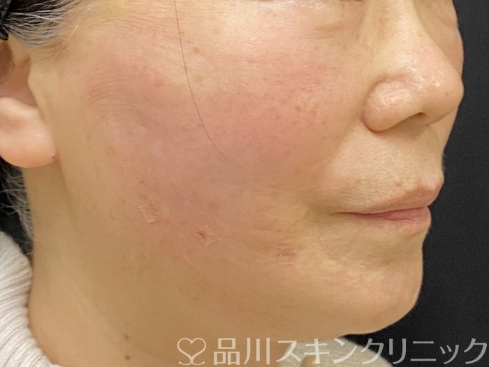 症例NO.73538のAFTER写真