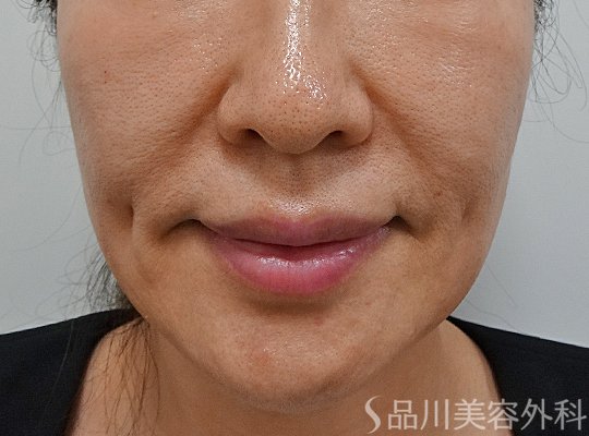 症例NO.62275のBEFORE写真