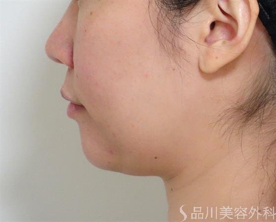 症例NO.36194のBEFORE写真