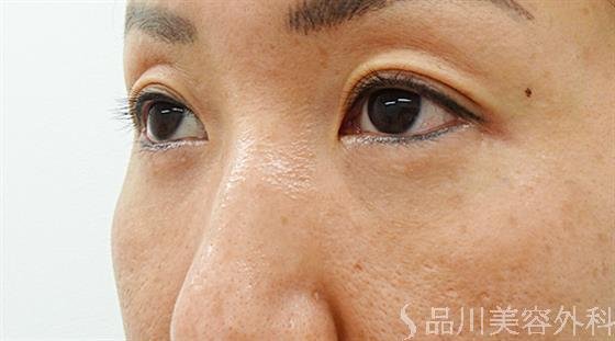 症例NO.44609のAFTER写真