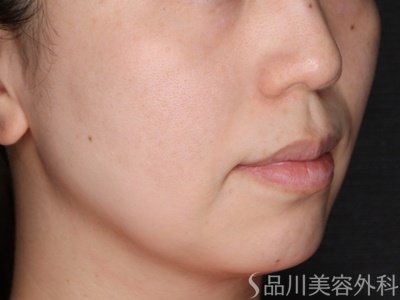 症例NO.74241のAFTER写真