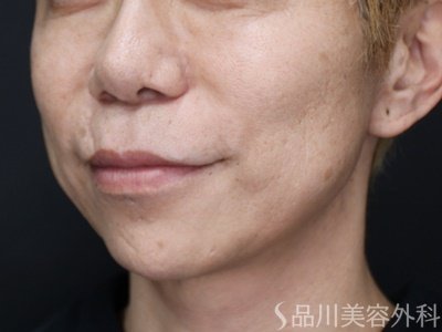 症例NO.74549のAFTER写真