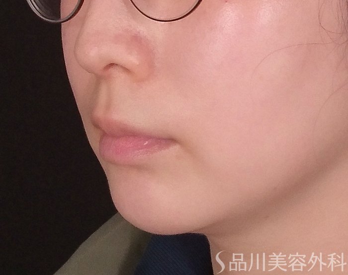 症例NO.69476のBEFORE写真