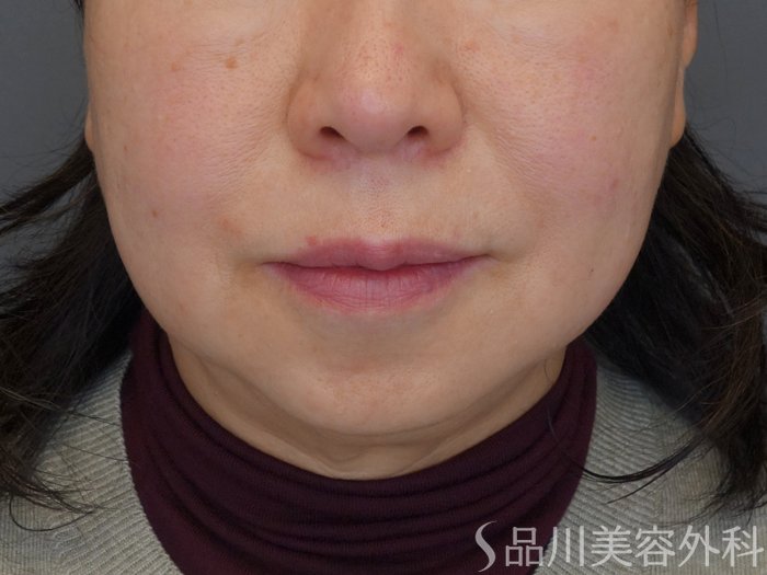 症例NO.72547のBEFORE写真