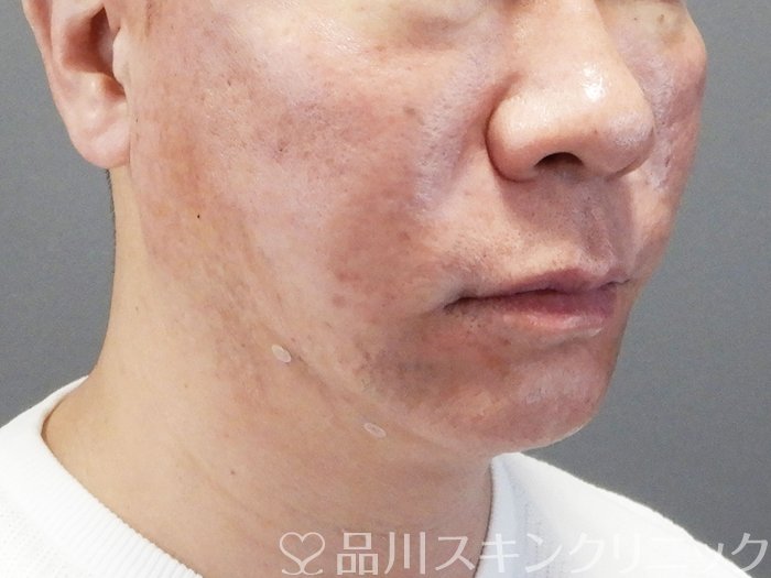 症例NO.73478のBEFORE写真