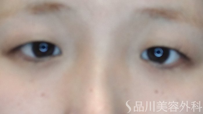 症例NO.71261のBEFORE写真