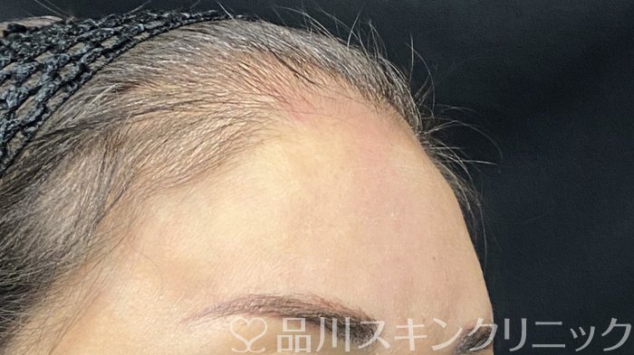 症例NO.75222のAFTER写真