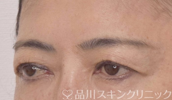 症例NO.62924のBEFORE写真