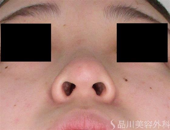 症例NO.60074のBEFORE写真