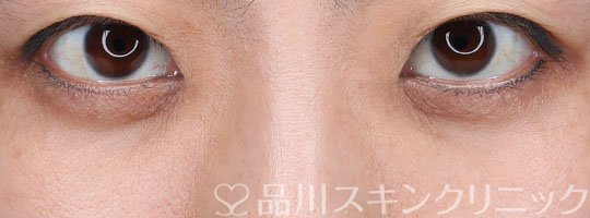 症例NO.74425のAFTER写真