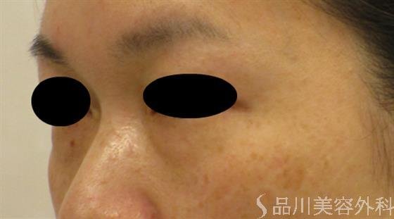 症例NO.48797のBEFORE写真