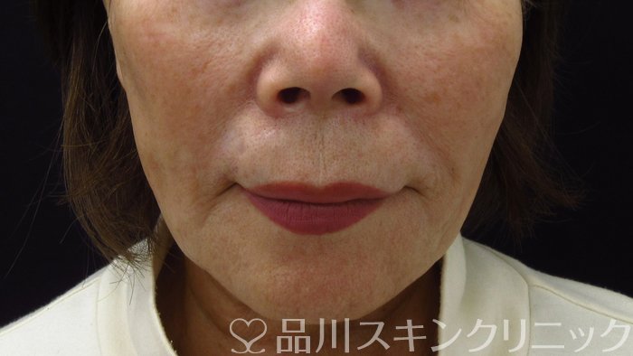 症例NO.73202のAFTER写真