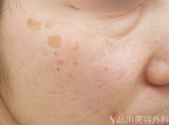 症例NO.14083のBEFORE写真
