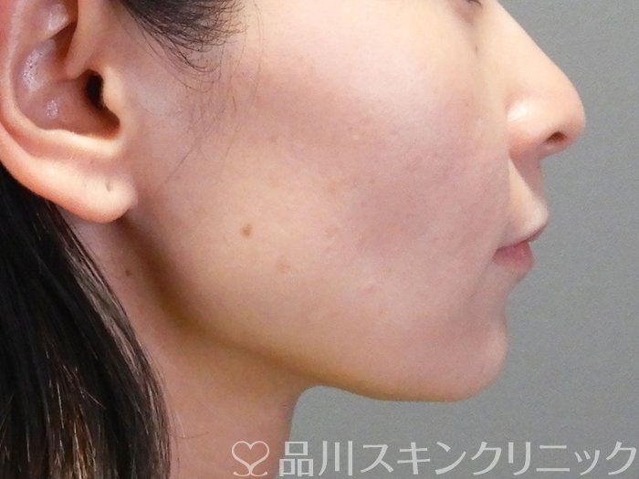 症例NO.74371のBEFORE写真