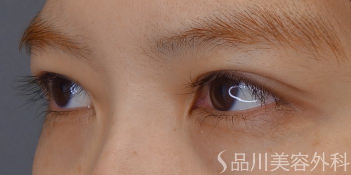 症例NO.68601のAFTER写真