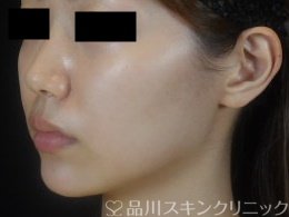 症例NO.74305のAFTER写真