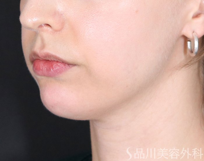 症例NO.73978のAFTER写真