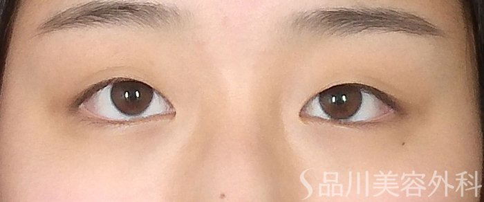 症例NO.65545のBEFORE写真