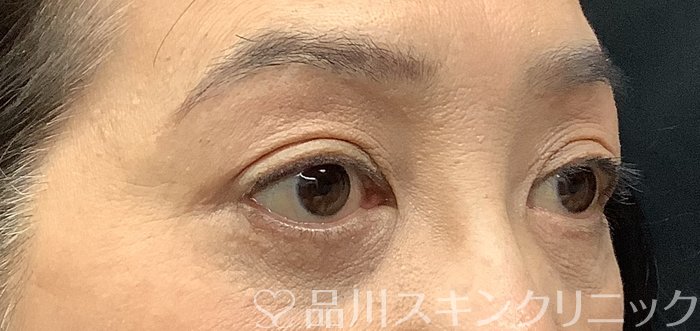 症例NO.69013のAFTER写真