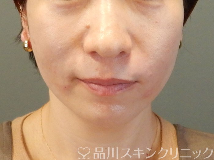 症例NO.62408のAFTER写真