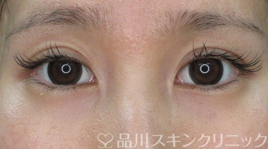 症例NO.71391のAFTER写真