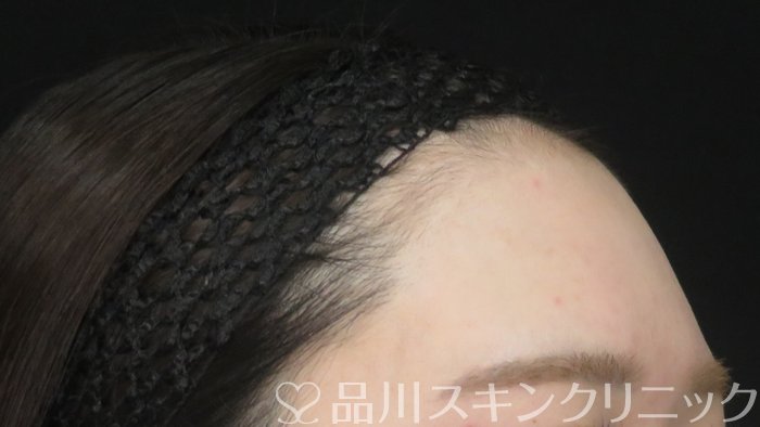 症例NO.71050のBEFORE写真