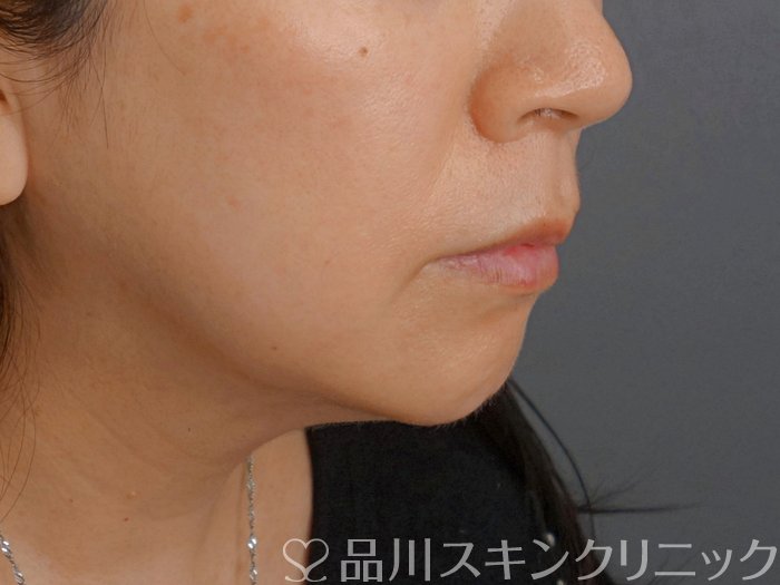 症例NO.74239のBEFORE写真