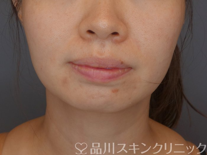 症例NO.71881のBEFORE写真